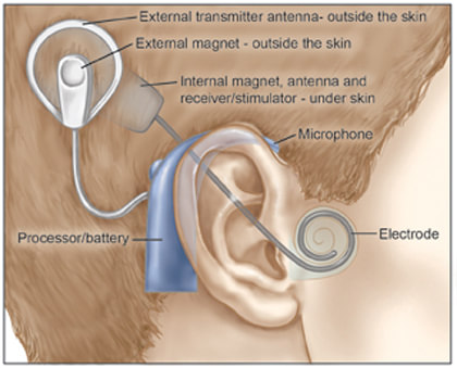Cochlear Implant External Diagram